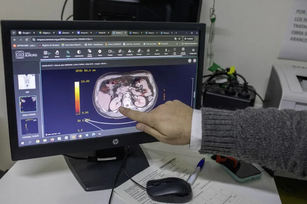 El cáncer de riñón es el sexto más frecuente en Argentina | APFDigital